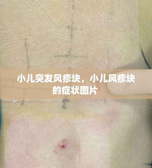 小儿突发风疹块,小儿风疹块的症状图片